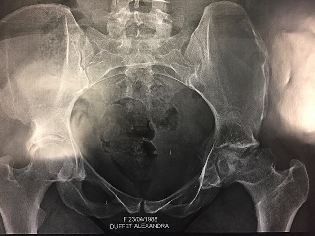 Chirurgie orthopédique et prothétique Saint-Saulve - Ostéonécrose tête ...